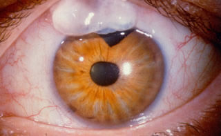 Cirugía de glaucoma en Metepec