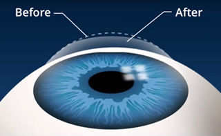 Tratamiuento de miopía hipermetropía astigmatismo
